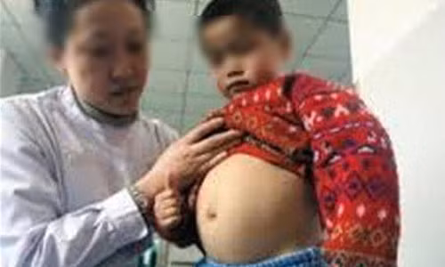 Cậu bé 4 tuổi mang thai chính người anh em song sinh của mình.