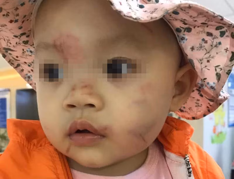 Nghi van be gai 14 thang bi “danh” bam dap o lop mam non Hoa Sen