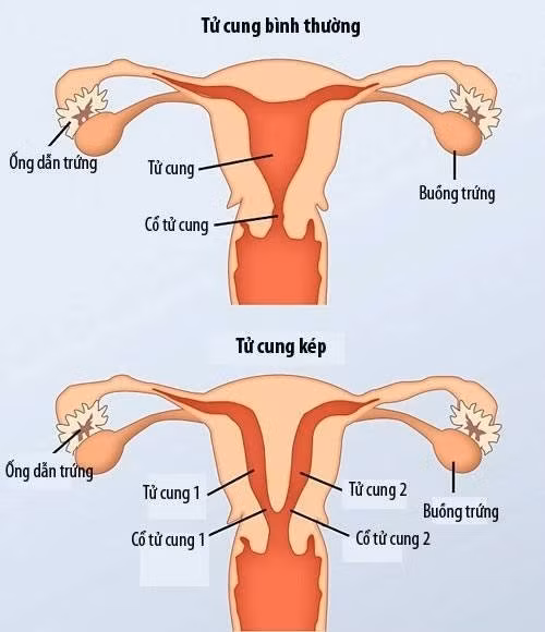 Co gai duoc phat hien co 2 tu cung, 2 am dao-Hinh-3