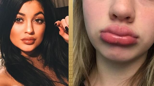 Thử thách Kylie Jenner Trào lưu bắt chước bờ môi dày gợi cảm của Kylie Jenner tưởng chừng vô hại nhưng lại tiềm tàng nhiều hiểm họa. Trò chơi thách thức người trẻ sử dụng các đồ dùng như ly tách, chai lọ, hít thật mạnh để "bơm môi". Từ khóa hashtag #kyliejennerchallenge có hàng triệu lượt tweet và chia sẻ trên Twitter và Instagram. Theo Babbletop, trò chơi có khả năng tổn thương vĩnh viễn vùng cơ môi và mạch môi, gây nên những vết thương không thể chữa lành.