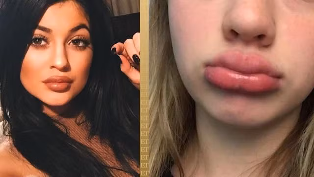 Thử thách Kylie Jenner Trào lưu bắt chước bờ môi dày gợi cảm của Kylie Jenner tưởng chừng vô hại nhưng lại tiềm tàng nhiều hiểm họa. Trò chơi thách thức người trẻ sử dụng các đồ dùng như ly tách, chai lọ, hít thật mạnh để "bơm môi". Từ khóa hashtag #kyliejennerchallenge có hàng triệu lượt tweet và chia sẻ trên Twitter và Instagram. Theo Babbletop, trò chơi có khả năng tổn thương vĩnh viễn vùng cơ môi và mạch môi, gây nên những vết thương không thể chữa lành.