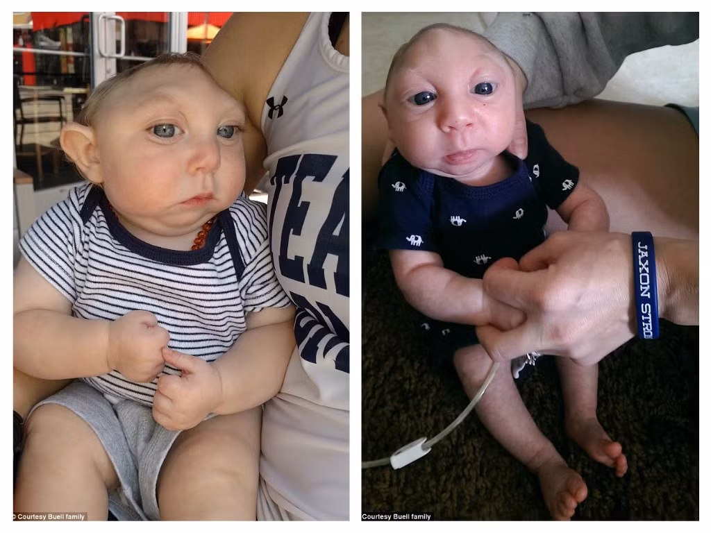 Tuy nhiên, cậu bé Jaxon Strong là ngoại lệ trong số các em bé không có hộp sọ. Bé vẫn chào đời và sống sót chỉ với một phần hộp sọ. Câu chuyện của em đã truyền cảm hứng nghị lực cho các gia đình trên khắp thế giới. 