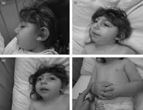 Có khoảng 1/4.859 bé sơ sinh trên toàn nước Mỹ bị mắc hội chứng mất não bẩm sinh và phần lớn đều tử vong ngay sau khi được sinh ra, theo số liệu từ Trung tâm Kiểm soát và Phòng ngừa Dịch bệnh Mỹ.