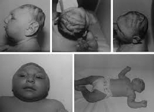 Dấu hiệu thông thường của chứng dị tật thiếu não này là dị tật đầu nhỏ, thiếu hộp sọ, dẫn đến con người chậm phát triển. Chứng bệnh này khiến bệnh nhân có thể sẽ không bao giờ đi bộ, nói chuyện, hay biết rằng mình đang đói, biết nghe, biết nhìn.