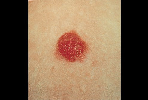 Chảy máu: Các nốt ruồi đột nhiên chảy máu bất thường, kèm theo đó là sưng tấy và nhiễm trùng thì bạn cần đến các cơ sơ y tế để được kiểm tra sớm nhất vì đây có thể là triệu chứng cảnh báo nguy cơ mắc bệnh ung thư hắc tố.