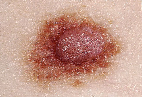 Độ lồi: Nếu nốt lạ nổi lồi trên da rõ nét thì việc kiểm tra là cần thiết. Bởi các khối u ác tính thường phát triển nhanh chóng về kích cỡ hoặc độ lớn. Một nốt ruồi cứ lớn dần, đổi màu, gây ngứa ngáy, khó chịu hoặc chảy máu thực sự là dấu hiệu đáng báo động.