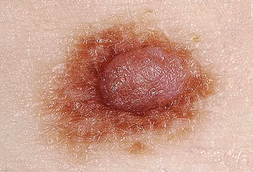 Độ lồi: Nếu nốt lạ nổi lồi trên da rõ nét thì việc kiểm tra là cần thiết. Bởi các khối u ác tính thường phát triển nhanh chóng về kích cỡ hoặc độ lớn. Một nốt ruồi cứ lớn dần, đổi màu, gây ngứa ngáy, khó chịu hoặc chảy máu thực sự là dấu hiệu đáng báo động.