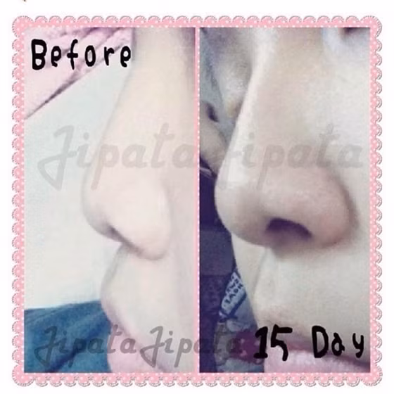 Cách sử dụng serum “thần dược” này rất đơn giản, chỉ cần thoa một lớp lên mũi. Sau đó massage từ 5-10 phút rồi dùng một loại kẹp, kẹp mũi từ 30-6- phút. Sau khi khách hàng bỏ kẹp và lột lớp serum đã khô trên mũi đi. Người bán cam kết làm liên tục hàng ngày trong một tháng, mũi sẽ cao rõ rệt khoảng 8mm, kèm theo đống hình ảnh của người sử dụng từ mũi tẹt, mũi to đã trở nên thon gọn, cao thẳng tắp.
