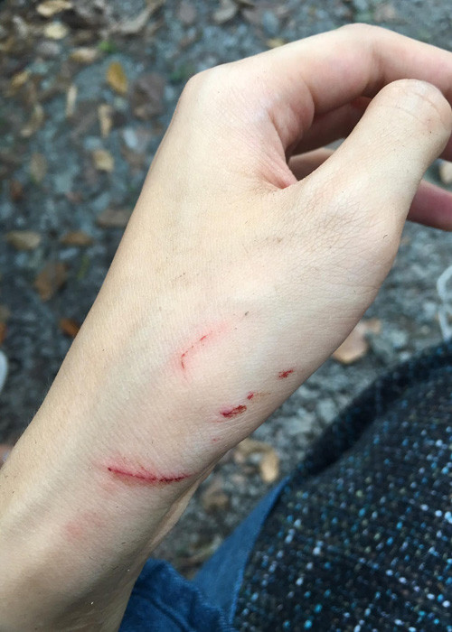 Hot girl sinh năm 1993 bị thương ở tay trong quá trình ghi hình cho bộ phim“Tấm Cám: Chuyện chưa kể”.