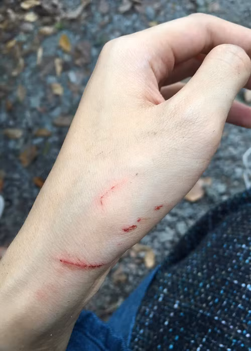 Hot girl sinh năm 1993 bị thương ở tay trong quá trình ghi hình cho bộ phim“Tấm Cám: Chuyện chưa kể”.