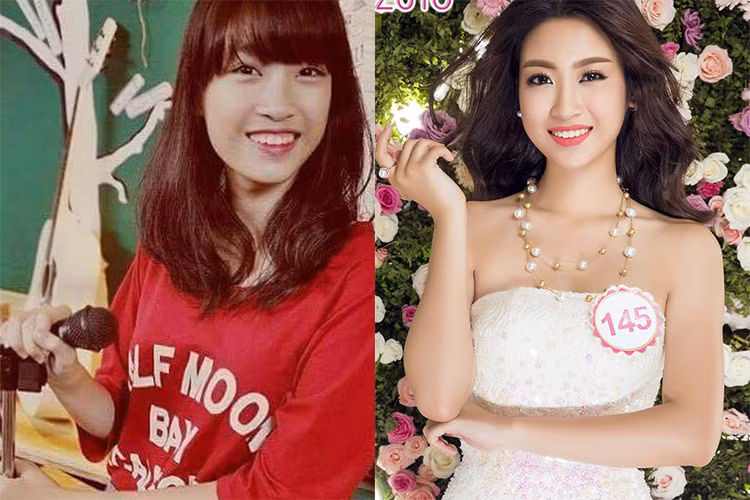 Ngoài ra, không ít ý kiến bày tỏ quan điểm, hàm răng trong quá khứ của Đỗ Mỹ Linh có phần hô hơn rất nhiều so với hiện tại. 