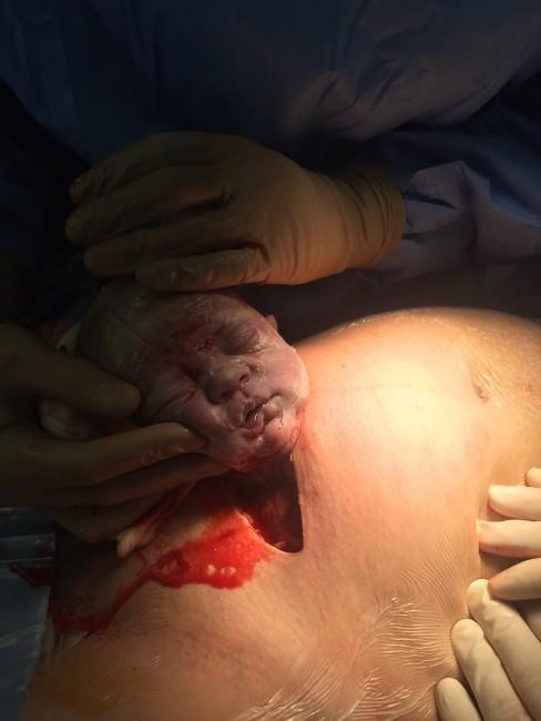 Một ca mổ đẻ thường được tiến hành trong khoảng 10 phút. Đầu tiên các bác sĩ sẽ khám sức khỏe tổng thể sau đó vệ sinh vùng lưng và tiến hành gây tê màng cứng cho sản phụ. Bác sĩ tiếp tục vệ sinh bụng bằng thuốc sát trùng, đặt ống thông tiểu ở bàng quang để giảm áp lực cho bàng quang. Hình ảnh: Phần đầu của em bé hoàn toàn được đưa ra ngoài qua thành bụng mẹ.