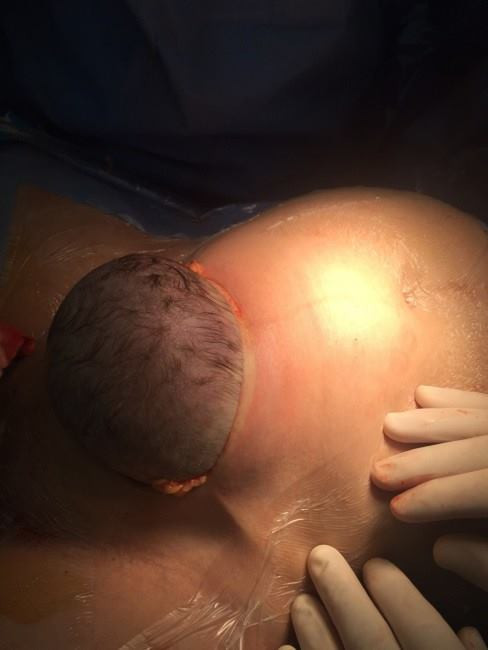 Hình ảnh vết rạch lớn trên bụng và khoảnh khắc một phần đầu em bé được đưa ra ngoài.