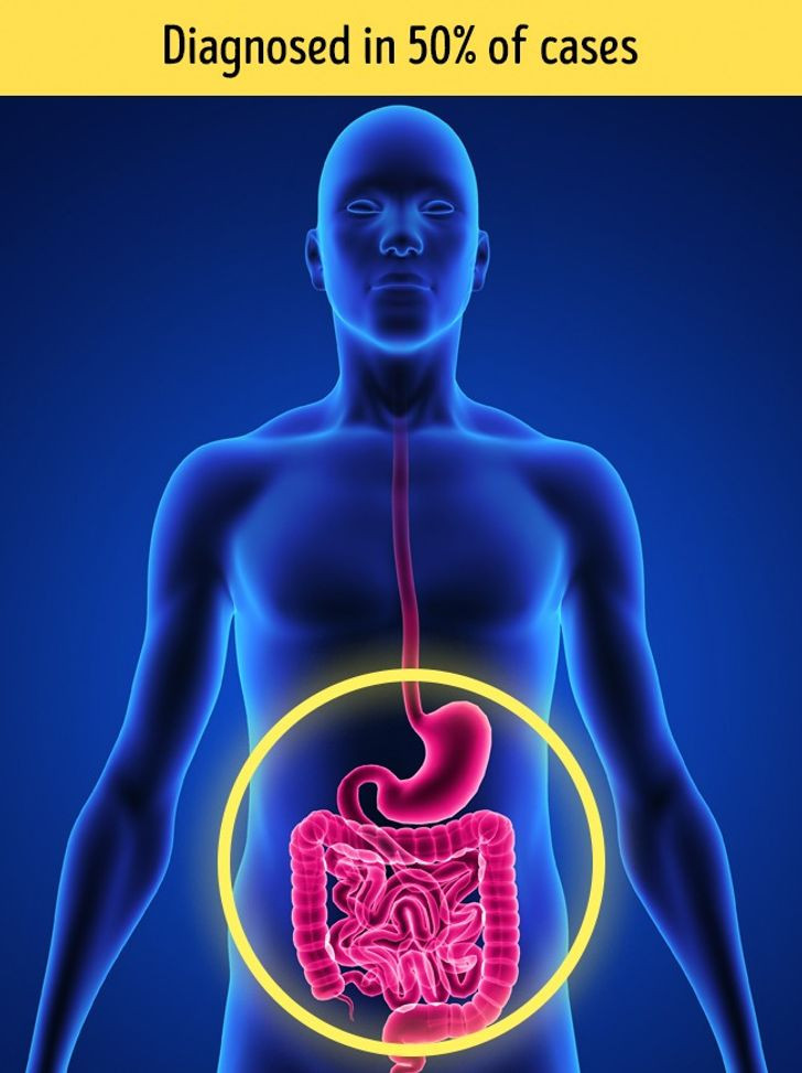 8. Đau bụng: Trước cơn đau tim, người bệnh có thể đau bụng từng cơn, triệu chứng giảm dần và sau đó trở lại trong thời gian ngắn. Ảnh: BS. 