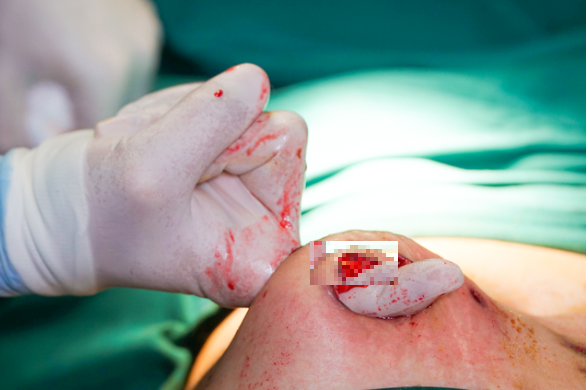 Tự tiêm thuốc tan mỡ, bụng bệnh nhân hoại tử trào mủ như "núi lửa" - Hình 2 Tu tiem thuoc tan mo, bung benh nhan hoai tu trao mu nhu