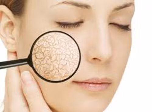 Da khô. Da là một trong những bộ phận lớn nhất cơ thể, rất cần nước để giữ ẩm. Nếu không cung cấp đủ nước, da trở nên khô, khó thoát mồ hôi khiến lớp dầu dư thừa dễ dàng tích tụ. Về lâu dài, uống ít nước khiến da khô khiến da mặt ngày càng trở nên tồi tệ, mụn mọc nhiều hơn.