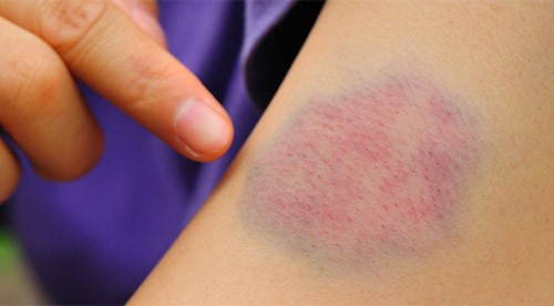 Nhiễm trùng, vết xước và các chỗ thâm tím khó lành cũng là dấu hiệu điển hình của tiểu đường. Điều này xảy ra do các mạch máu bị hư hại bởi có quá nhiều glucose di chuyển trong các tĩnh mạch, động mạch. Nó khiến cho máu khó lưu thông đến các vùng khác nhau của cơ thể - một điều cần thiết để vá lành vết thương.