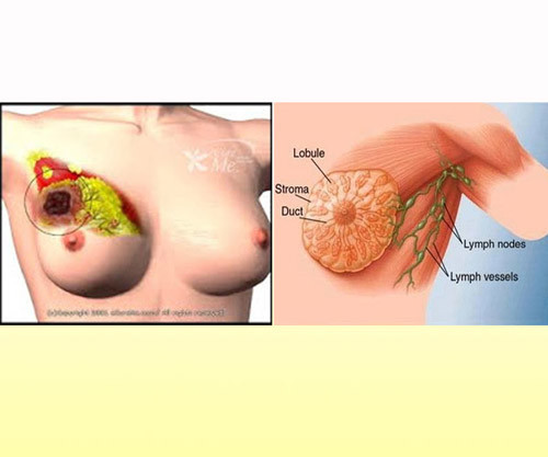 “Chỉ cần đi khám bác sĩ khi phát hiện u, cục”. Như trình bày ở trên, biểu hiện của ung thư vú không chỉ là những u, cục mà còn những mẩn đỏ. Chính vì vậy, bạn nên đi khám bác sĩ khi phát hiện những dấu hiệu bất thường thay vì chỉ khi nhìn thấy những khối u.