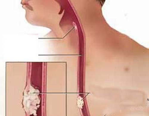 Thực quản. Đàn ông 60 tuổi trở lên có khả năng gặp các vấn đề về thực quản lớn hơn gấp 3 lần so với phụ nữ. Hầu hết nguyên nhân gây bệnh bắt nguồn từ lối sống và các yếu tố môi trường. Chẳng hạn, thói quen uống rượu, hút thuốc lá, ít ăn trái cây… gây hiện tượng trào ngược dạ dày ở lượng lớn nam giới. Việc không được quan tâm đúng mực khiến các tế bào thực quản dễ bị tổn hại, làm tăng nguy cơ mắc bệnh nguy hiểm này.