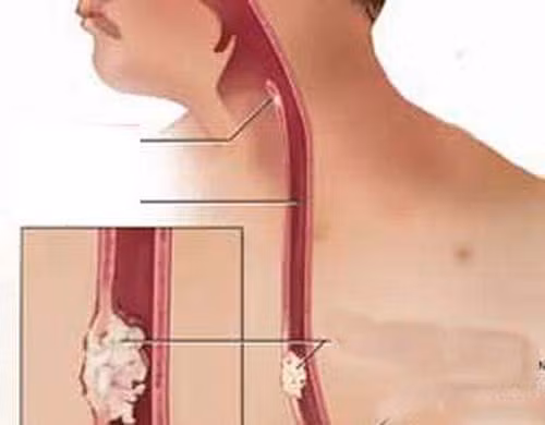 Thực quản. Đàn ông 60 tuổi trở lên có khả năng gặp các vấn đề về thực quản lớn hơn gấp 3 lần so với phụ nữ. Hầu hết nguyên nhân gây bệnh bắt nguồn từ lối sống và các yếu tố môi trường. Chẳng hạn, thói quen uống rượu, hút thuốc lá, ít ăn trái cây… gây hiện tượng trào ngược dạ dày ở lượng lớn nam giới. Việc không được quan tâm đúng mực khiến các tế bào thực quản dễ bị tổn hại, làm tăng nguy cơ mắc bệnh nguy hiểm này.