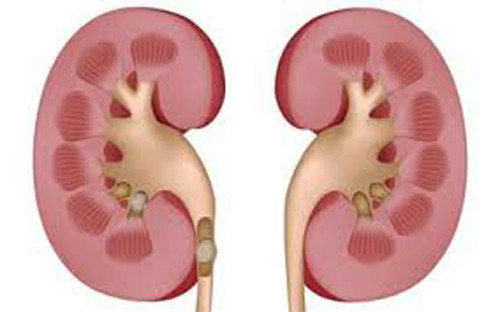 Bên cạnh đó, canxi cũng bị loại bỏ khỏi xương và có trong nước tiểu, canxi dư thừa có thể tích tụ trong thận và tạo thành sỏi thận.