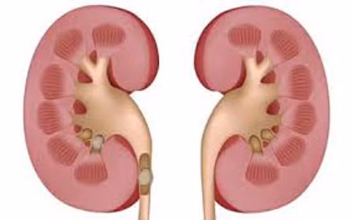 Bên cạnh đó, canxi cũng bị loại bỏ khỏi xương và có trong nước tiểu, canxi dư thừa có thể tích tụ trong thận và tạo thành sỏi thận.