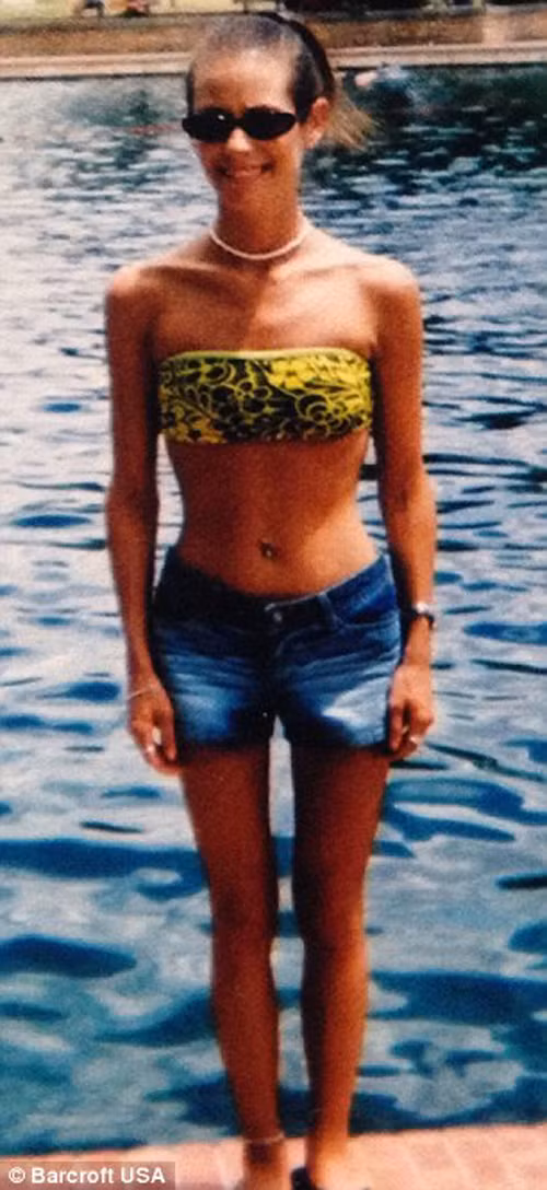 Khi 16 tuổi, thân hình Laura gầy guộc do mắc chứng biếng ăn. Tình trạng càng tồi tệ hơn khi 3 năm sau cân nặng cô giảm mạnh, chỉ còn 37kg.