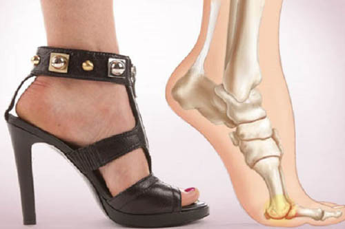 Hạn chế đi giày cao gót. Giày cao gót từng được chứng minh gây nhiều thiệt hại cho cơ bắp, khớp, dây chằng ở bàn chân, cẳng chân, hông và thắt lưng. Chính vì vậy, bạn nên chọn một đôi giày bệt phù hợp thay vì tự hành hạ mình với đôi giày cao gót.