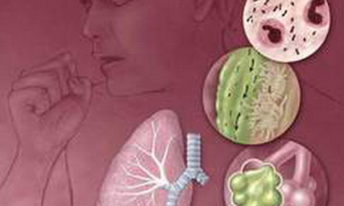 Quá trình hô hấp bạn có thể hít những vi khuẩn có hại vào trong phổi gây nhiễm trùng, viêm phổi.