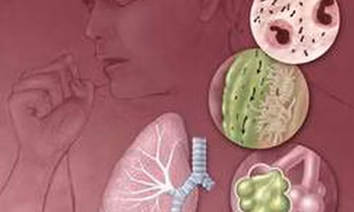 Quá trình hô hấp bạn có thể hít những vi khuẩn có hại vào trong phổi gây nhiễm trùng, viêm phổi.