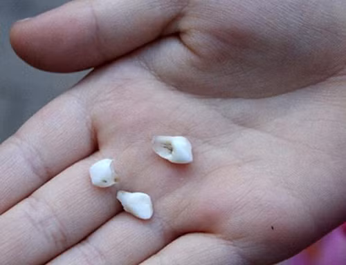 Rụng răng. Rụng răng là kết quả thấy rõ khi mắc các bệnh về lợi. Lúc này, răng bắt đầu rụng cùng cảm giác đau nhức vô cùng. Thiếu 1 – 2 răng có thể không khiến bạn cảm nhận rõ rệt song mất nhiều hơn sẽ khiến thú vui ăn uống của bạn tiêu tan.