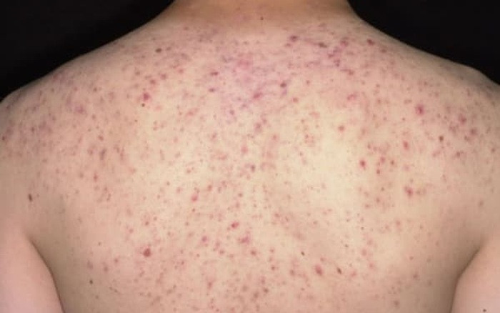 Trị mụn tại spa, bệnh nhân bị rối loạn nhịp tim vì thuốc tê Tri mun tai spa, benh nhan bi roi loan nhip tim vi thuoc te