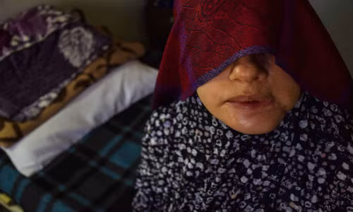 Từ năm 2006, hàng ngàn ca phẫu thuật đã được tiến hành tại bệnh viện Mowasah. Đối với ca phẫu thuật thẩm mỹ khuôn mặt, bệnh nhân không thể lấy lại gương mặt nguyên vẹn như xưa. Các chuyên gia cho biết, những nạn nhân với khuôn mặt biến dạng thường rơi và trạng thái trầm cảm, lo âu. Ảnh: Khuôn mặt của Laila biến dạng khiến cô không dám nhìn mọi người.