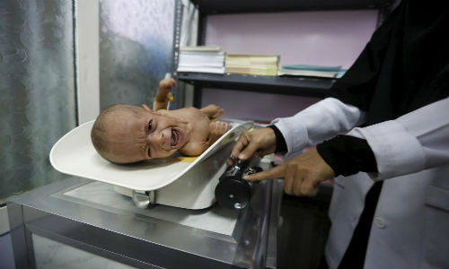 Bé gái suy dinh dưỡng gào khóc khi được đặt lên bàn cân ở Sanaa ngày 10/2/2016.