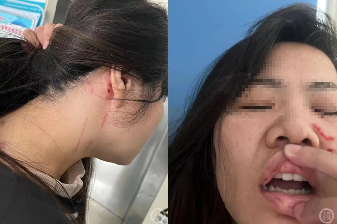 Phẫn nộ cô gái bị đánh nhập viện vì từ chối đi xem mắt - Hình 2 Phan no co gai bi danh nhap vien vi tu choi di xem mat-Hinh-2