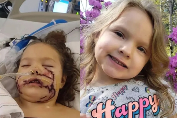 Bi cho pit bull tan cong, co be 6 tuoi phai khau 1.000 mui