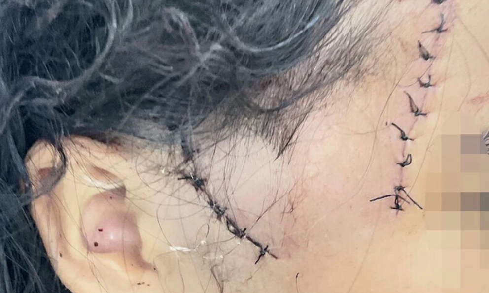 Đồng Nai: Sức khỏe bé gái bị cha dượng gây thương tích đã ổn Dong Nai: Suc khoe be gai bi cha duong gay thuong tich da on