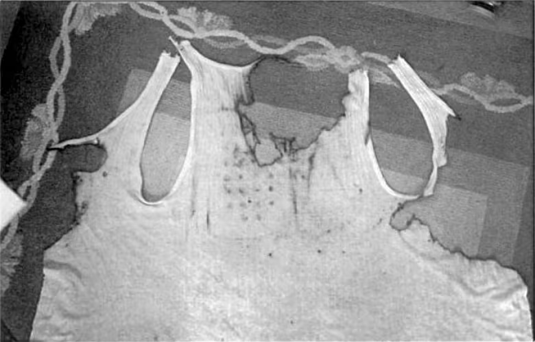 Mặc dù một số người hoài nghi về câu chuyện này, nhưng sự thực về vụ việc vẫn còn là một bí ẩn và đặc biệt là với sự tồn tại của các dấu vết không mờ đi trên cơ thể Michalak suốt 32 năm.