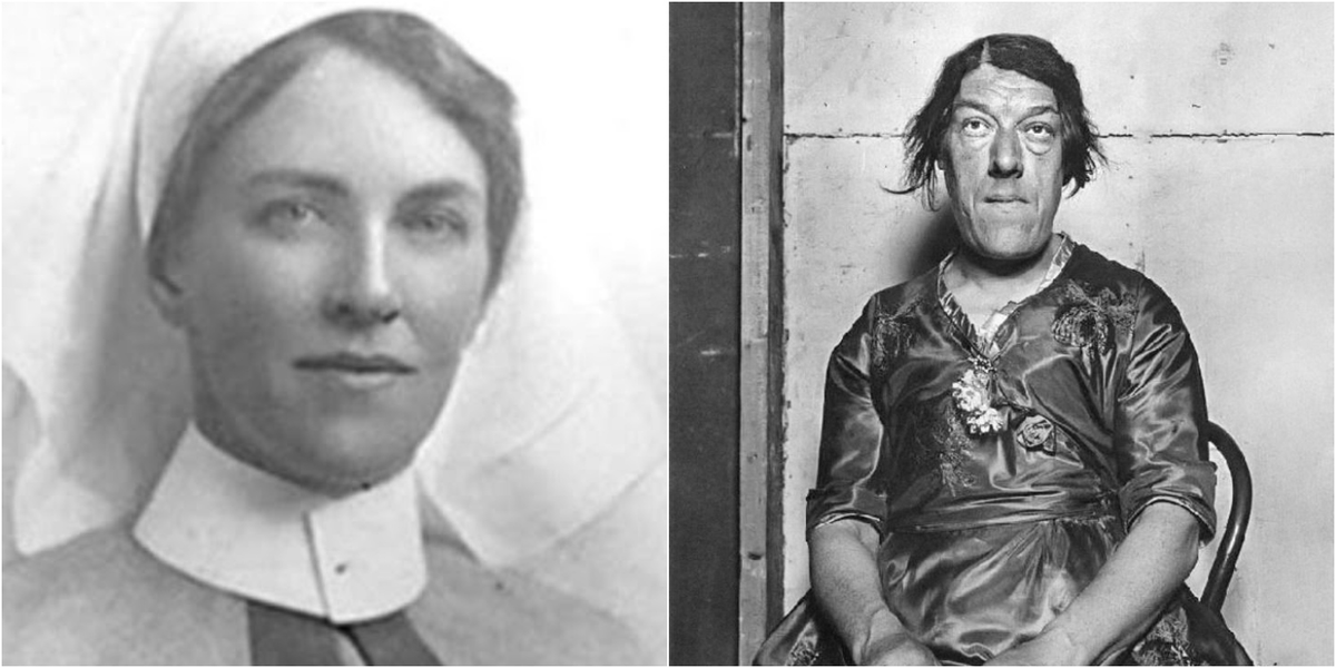 6. Mary Ann Webster: Mắc chứng phì đại liên tục, Mary Ann Webster có khuôn mặt bất thường và cảm thấy đau đớn.