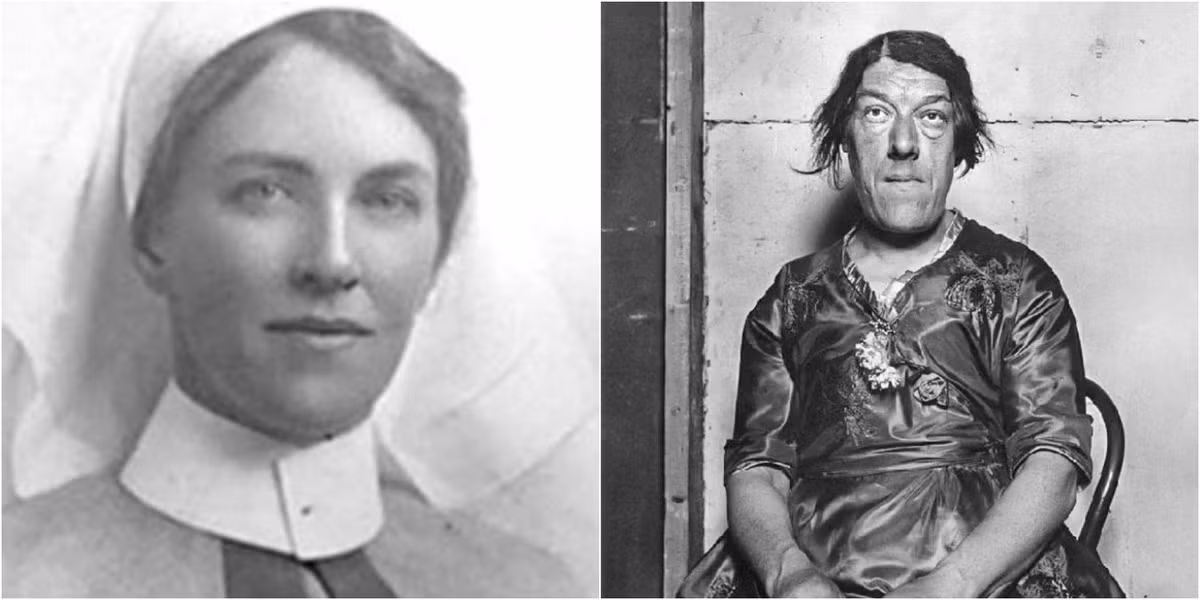 6. Mary Ann Webster: Mắc chứng phì đại liên tục, Mary Ann Webster có khuôn mặt bất thường và cảm thấy đau đớn.