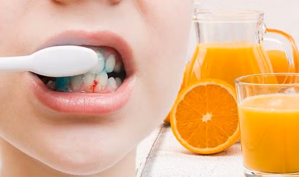 Nướu đỏ, chảy máu cũng là dấu hiệu phổ biến của thiếu vitamin C. Ảnh: express.
