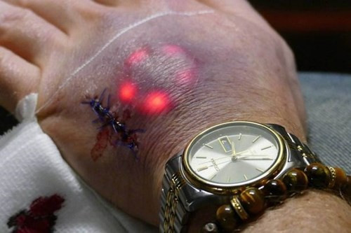 Báo chí nước ngoài còn đưa tin, dự kiến dịch vụ cấy đèn LED dưới da sẽ được công ty Grindhouse Wetware (chuyên về công nghệ sinh học, có trụ sở ở Mỹ) đưa vào thị trường vào năm tới.