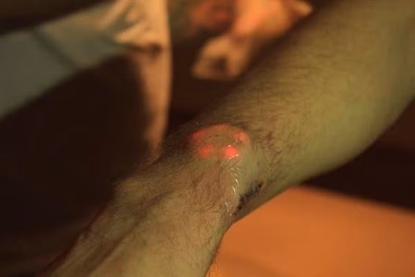 Sau khi hình ảnh những bàn tay phát sáng do được cấy đèn dưới da phát tán trên Facebook, trò vui rùng rợn này đã bất ngờ tạo thành "mốt" với sự quan tâm, hưởng ứng của nhiều bạn trẻ phương Tây.