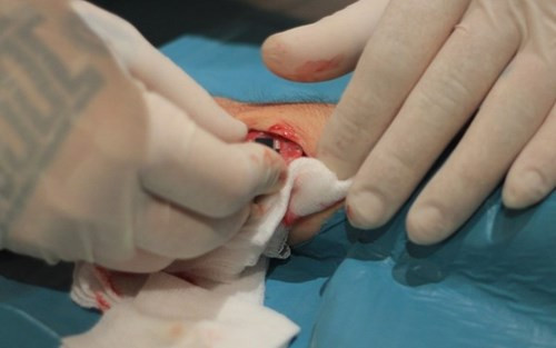 Để thực hiện cấy đèn LED dưới da, các "dị nhân" bắt buộc phải chịu đựng đau đớn, làm một tiểu phẫu là rạch da trên mu bàn tay, tạo khoảng trống và... đưa con chip mang tên Northstar V1 vào bên trong sau đó khâu lại bằng chỉ y tế.