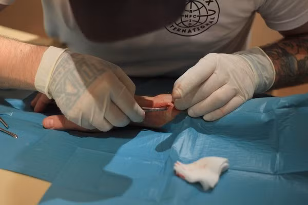 Hình ảnh cận cảnh cuộc tiểu phẫu cấy đèn LED dưới da đã được một vài trang mạng quốc tế cập nhật mới đây khiến ai xem qua cũng phải rùng mình. Chip Northstar chỉ dài hơn ngón tay cái, dù có kích thước nhỏ nhưng việc "nhét" nó dưới da mu bàn tay cũng không phải là điều dễ dàng.