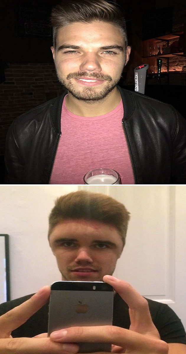  Chàng trai xui xẻo bị dị ứng với thuốc nhuộm tóc khiến khuôn mặt “biến dạng”.