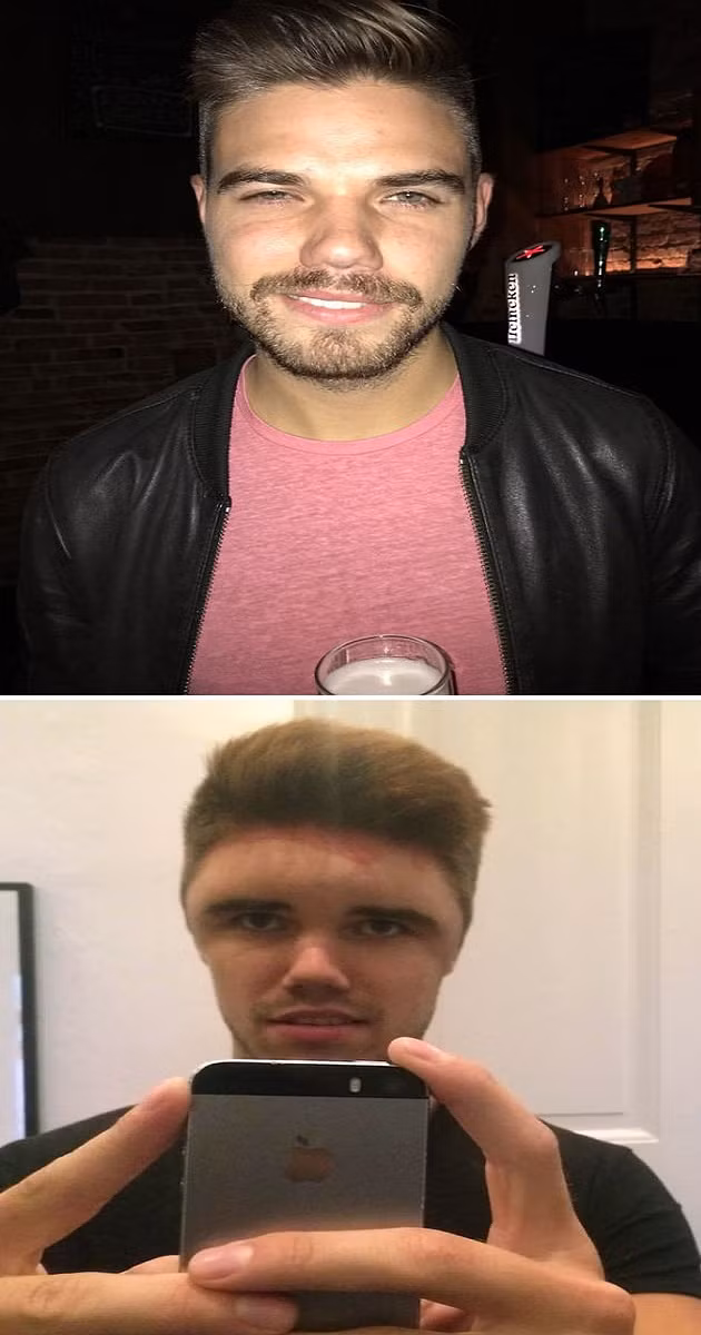  Chàng trai xui xẻo bị dị ứng với thuốc nhuộm tóc khiến khuôn mặt “biến dạng”.