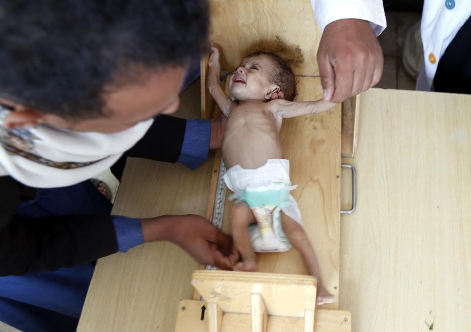 Các bác sĩ đặt em nhỏ bị suy dinh dưỡng lên bàn cân trong bệnh viện ở thủ đô Sanaa.