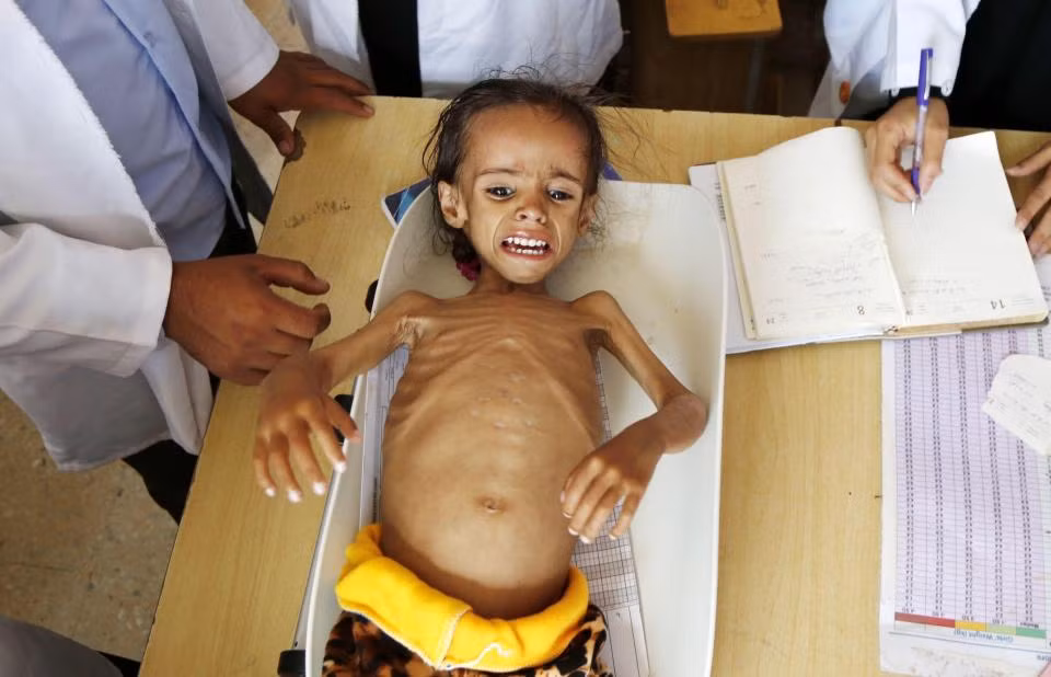 Chien tranh lien mien, hang trieu tre Yemen bi suy dinh duong-Hinh-2