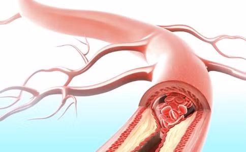 Ngăn ngừa chứng xơ cứng động mạch bằng cách sớm phát hiện và điều trị sớm bệnh cao huyết áp, mỡ máu, béo phì và nhiều bệnh khác. Ảnh: 99.